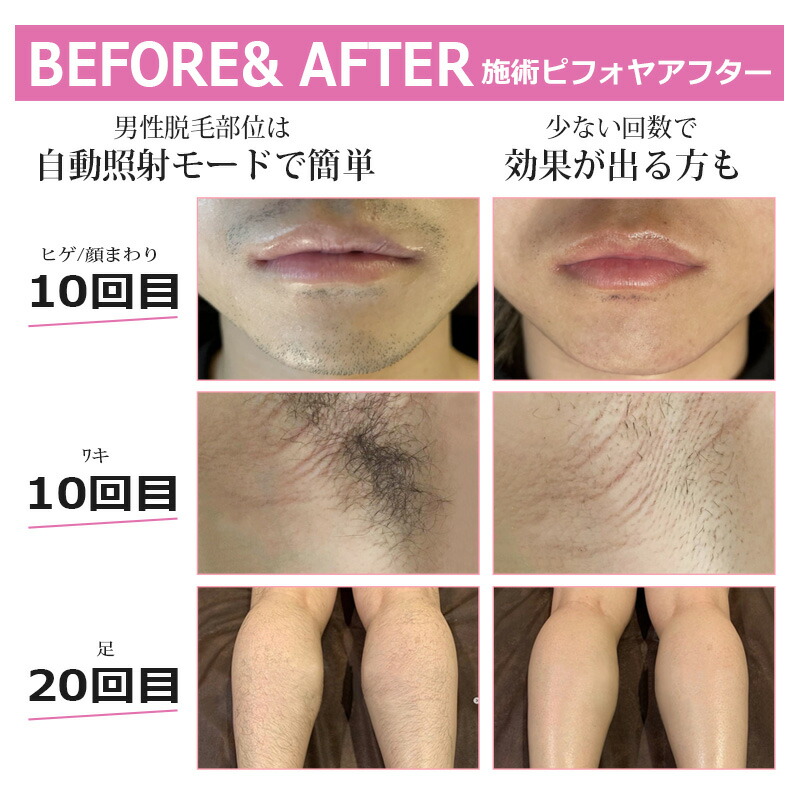 楽天市場】【見逃すな爆安セール限定価格19,800円】脱毛器 照射回数