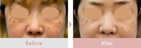 エレクトロポレーション（イオン導入）｜美容皮膚科なら湘南美容