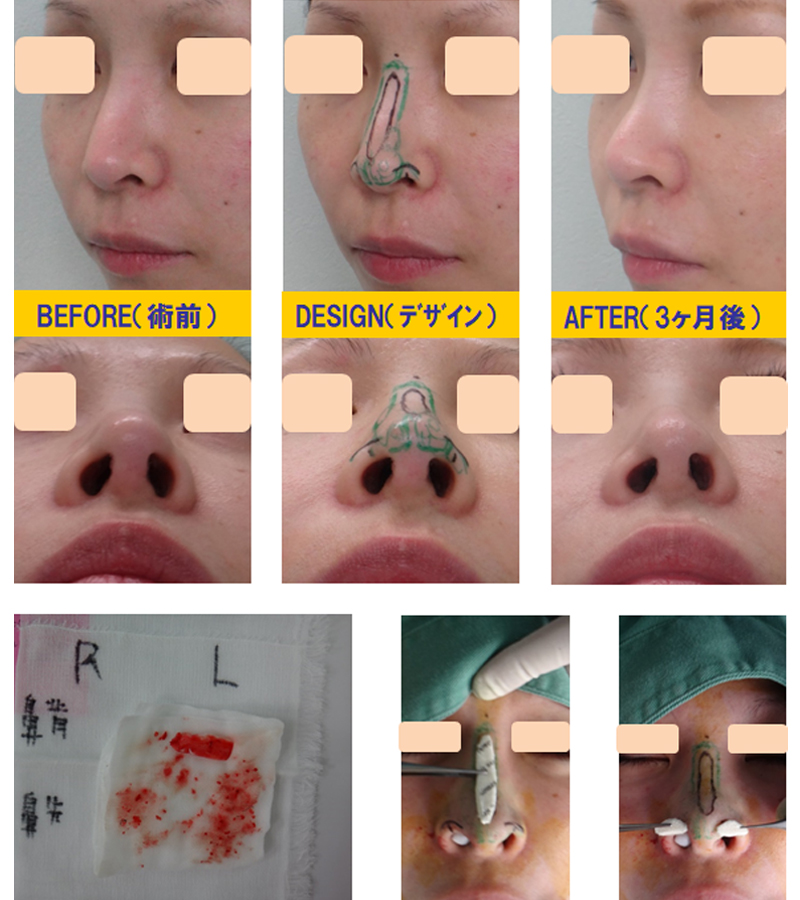 完全クローズ法でアップノーズにする手術 編 | 美容整形の他院修正治療