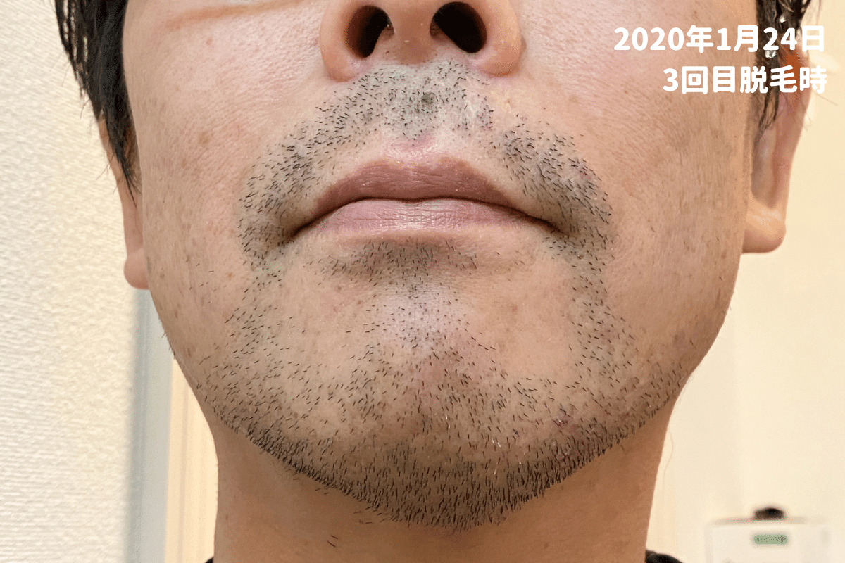 トリアで髭脱毛・痛みや効果をレビュー！3カ月間でどれだけヒゲが減る