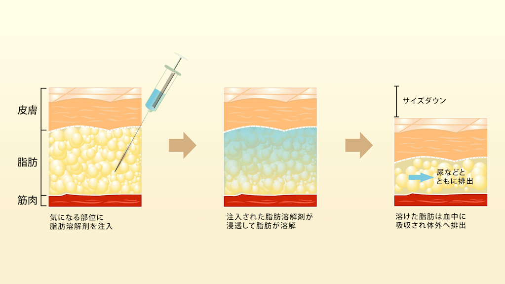 脂肪溶解注射(FatXコア) | 徳島の美容整形ならしらさぎ形成クリニック