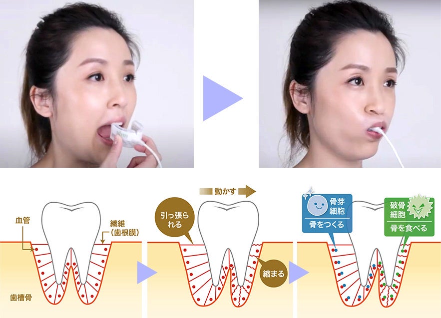 矯正期間を従来の1／2（半分の期間）にして早く終わらせる「光加速