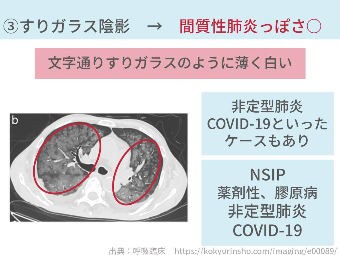 間質性肺炎を診断する方法【悲報：実はめちゃ難易度たかいです】※医療